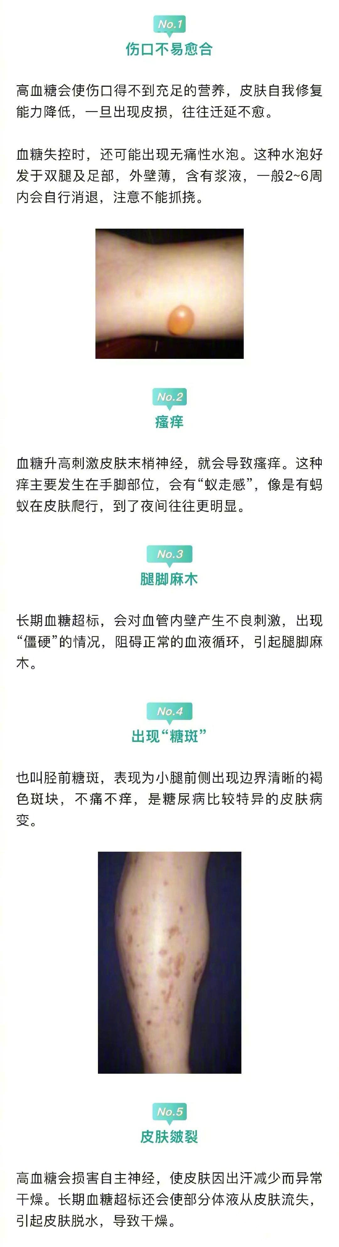 医生说下肢是人体自带的血糖仪