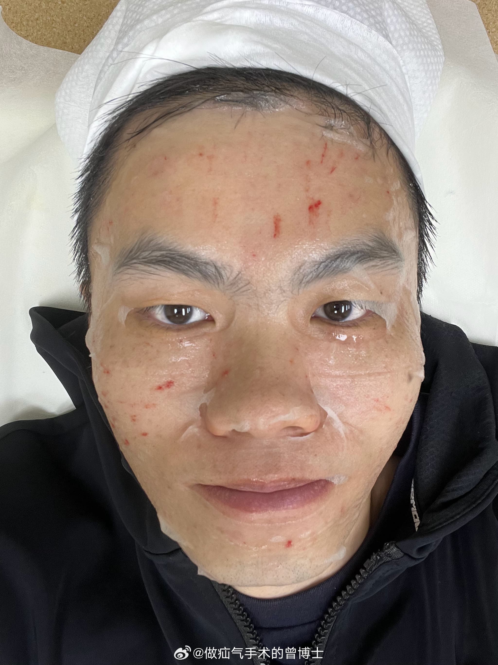 Qi Wei’s Botox Mishap Sparks Nationwide Debate on Cosmetic Safety, Industry Practices, and Beauty Standards in China