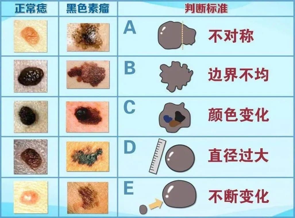 会癌变的痣一般有5个特征