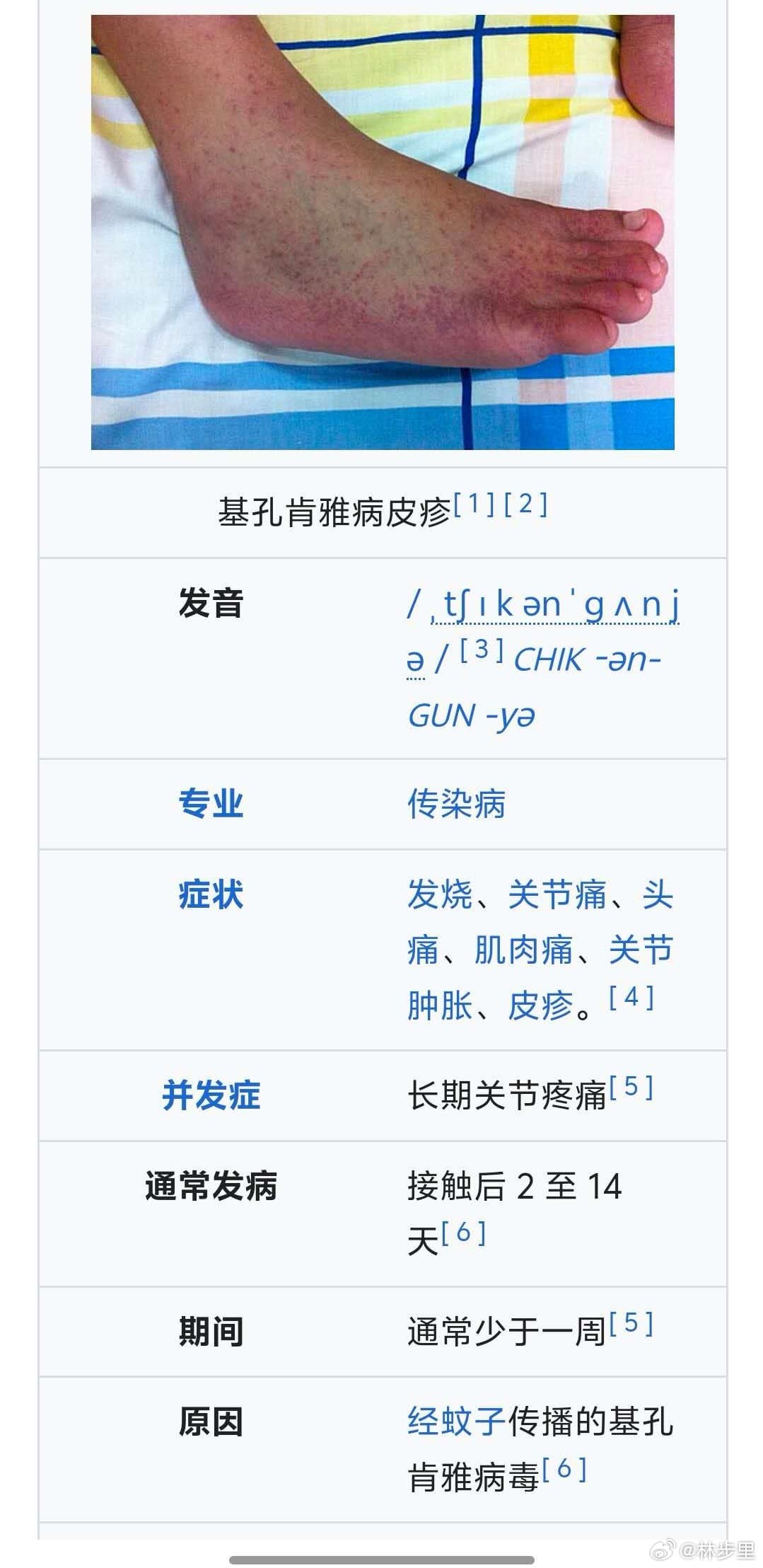 佛山顺德区确诊478例基孔肯雅热