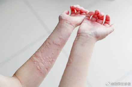 The Trending Remedy: Massaging Steamed Eggs with Sesame Oil for Eczema Treatment