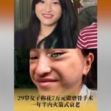 A 29-year-old woman from Guangdong, China, has claimed that after undergoing a facial bone-grinding procedure for around 70,000 yuan, she has experienced drastic and rapid aging. The woman, who only wants to be referred to as 'Deng', explains that while she had only initially planned to undergo a lower jaw surgery to achieve a more streamlined and refined facial profile, she was ultimately persuaded by the advice of the cosmetic surgery clinic to also undergo operations on her cheekbones and jawline.