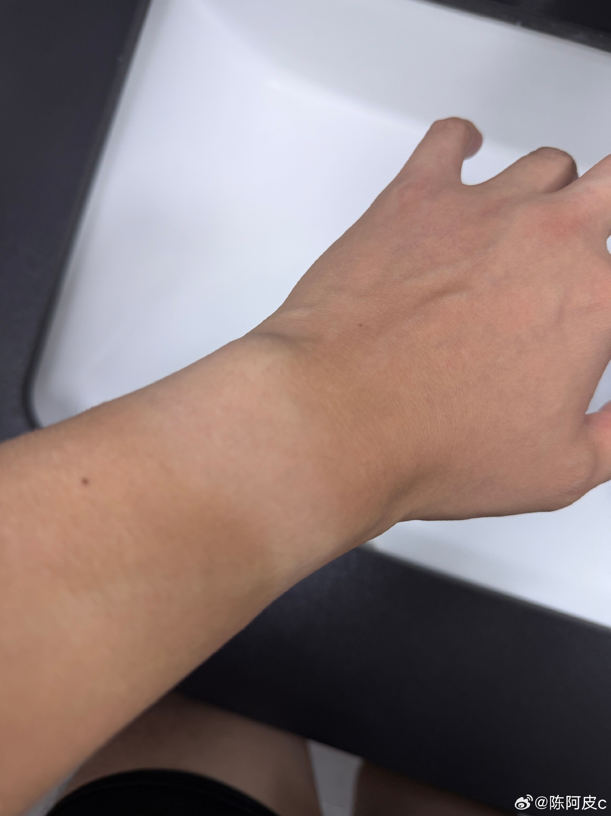 China's 'First Fitness-Band Victims' Report Wrist Trouble; Dermatologists Point to Allergies, Not Radiation