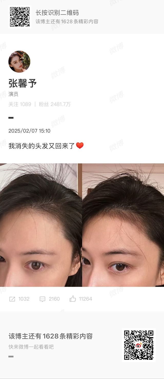 Zhang Xinyu's Miraculous Hair Regrowth: A Story of Resilience and Inner Beauty