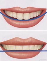 Many people believe that the attractiveness of a smile is closely related to facial structure and features, but in reality, a beautiful smile is influenced by a multitude of factors, including mouth width, zygomatic muscles, lip lines, and cheekbones. Research suggests that a smile is considered more aesthetically pleasing when the mouth is moderately wide or slightly larger, the zygomatic muscles are well-defined, the upper lip forms a gentle curve, and the cheekbones are prominent. For instance, a person with a wider mouth can smile more broadly, showcasing their teeth and conveying a sense of friendliness and approachability. On the other hand, individuals with smaller mouths may find it more challenging to smile without appearing awkward or strained.