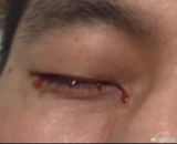 A shocking incident has come to light in Shaanxi's Xianyang, where a man's habit of picking his nose led to a severe health crisis. The man, known as Li Ming, had a long-standing habit of digging his nose, which his wife, Zhang Hua, had often warned him about. However, Li Ming never took her warnings seriously, believing it to be a harmless habit. That was until the day he experienced severe pain in his nasal cavity, followed by a gush of warm liquid, which turned out to be blood. The incident led to Li Ming being rushed to the hospital, where doctors diagnosed that his nasal cavity's arterial blood vessel had ruptured due to his habit of nose-picking.