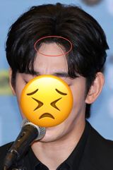 A recent social media frenzy has erupted over a photo of Korean celebrity Kim Soo-hyun's tongue, which appears to show an unusual growth, sparking concerns among fans and netizens. The image, taken during a press conference, has been circulating widely online, with many speculating about the possible health implications. However, medical experts have weighed in, cautioning that it is impossible to make an accurate diagnosis based solely on a photograph.