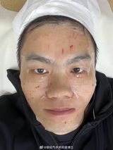 Chinese actress and singer Qi Wei has sparked a wave of conversation across social media she had over‑indulged in medical‑aesthetic treatments. During a live broadcast last week, the 44‑year‑old star explained that a series of botox injections had left her eyebrows “stiff and unable to move,” resulting in a drooping effect around her eyes that she described as “吊梢眼” – a term that translates loosely to “slanted eyes.” The candid confession, posted on the micro‑blogging platform Weibo, quickly became a trending topic, drawing both praise and reflection from fans, fellow celebrities and industry observers.